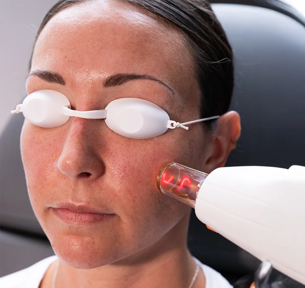 Close-up of a woman undergoing a facial treatment. She wears protective eye shields as a white handheld device with a glowing red tip is applied near her cheek, causing slight redness. The background is blurred, showing a dark gray or black chair, with lighting focused on her face. - Skin Resurfacing ResurFX in Queensbury, NY