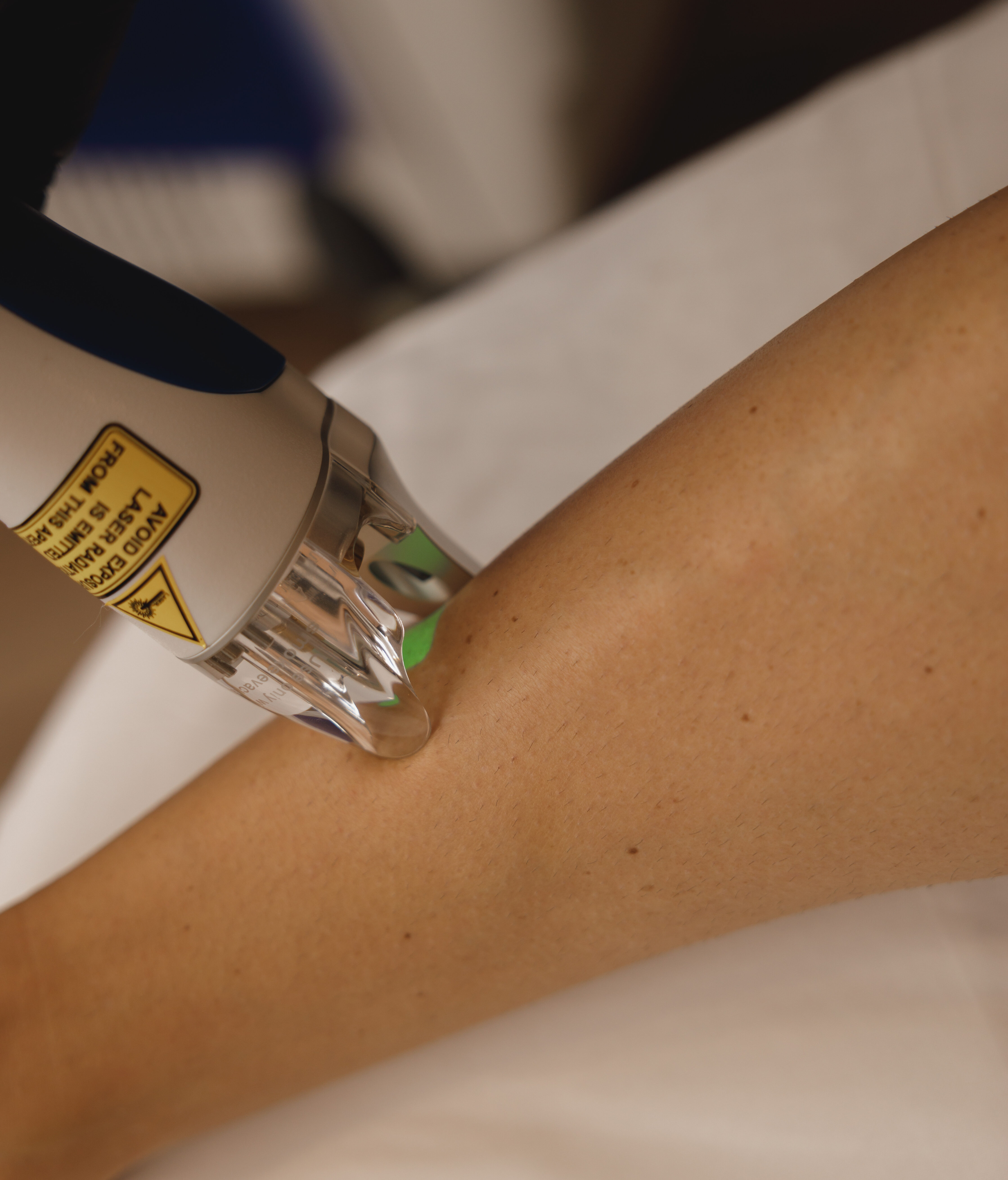 Laser hair removal treatment being performed in a female patients leg.